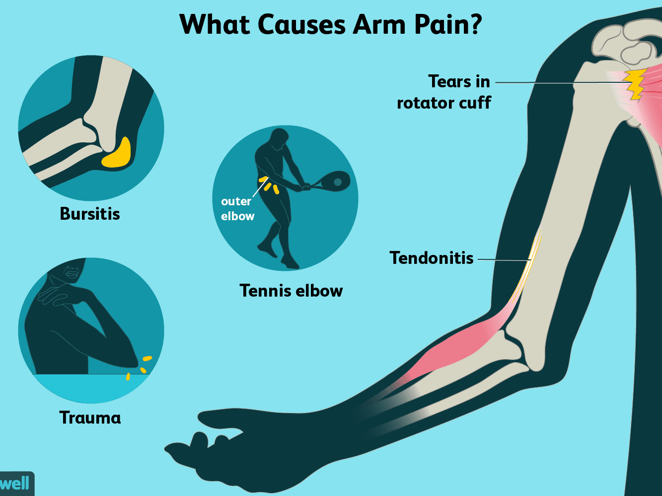 how-to-cure-muscle-pain-in-the-upper-arm