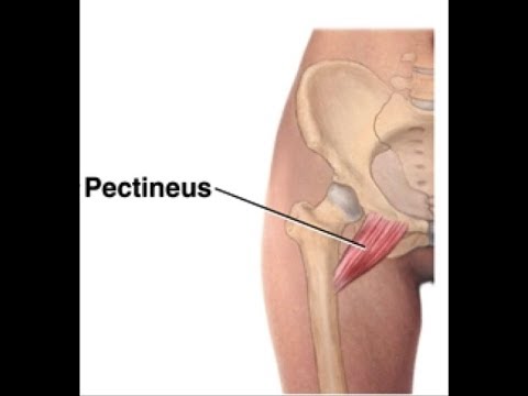 Pectineo-femoral pinch syndrome: A common cause of groin