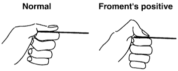 Froment's sign test