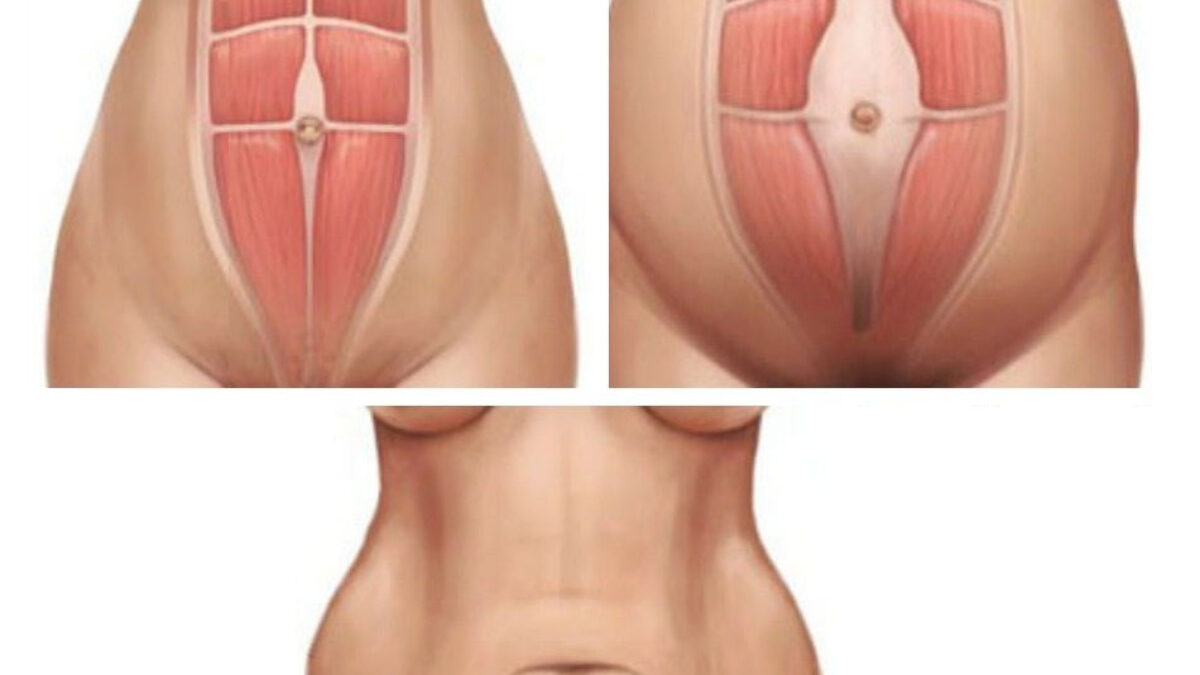 Facts and Tips for Healing Diastasis Recti, Part 1