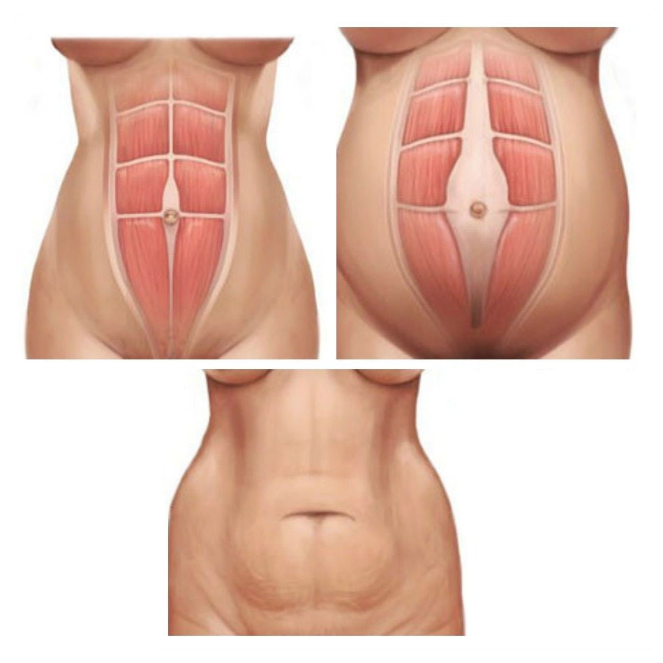 Front view of patient's abdominal taping (rectus abdominus and