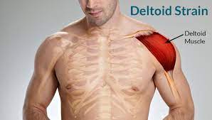 Deltoid muscle strain