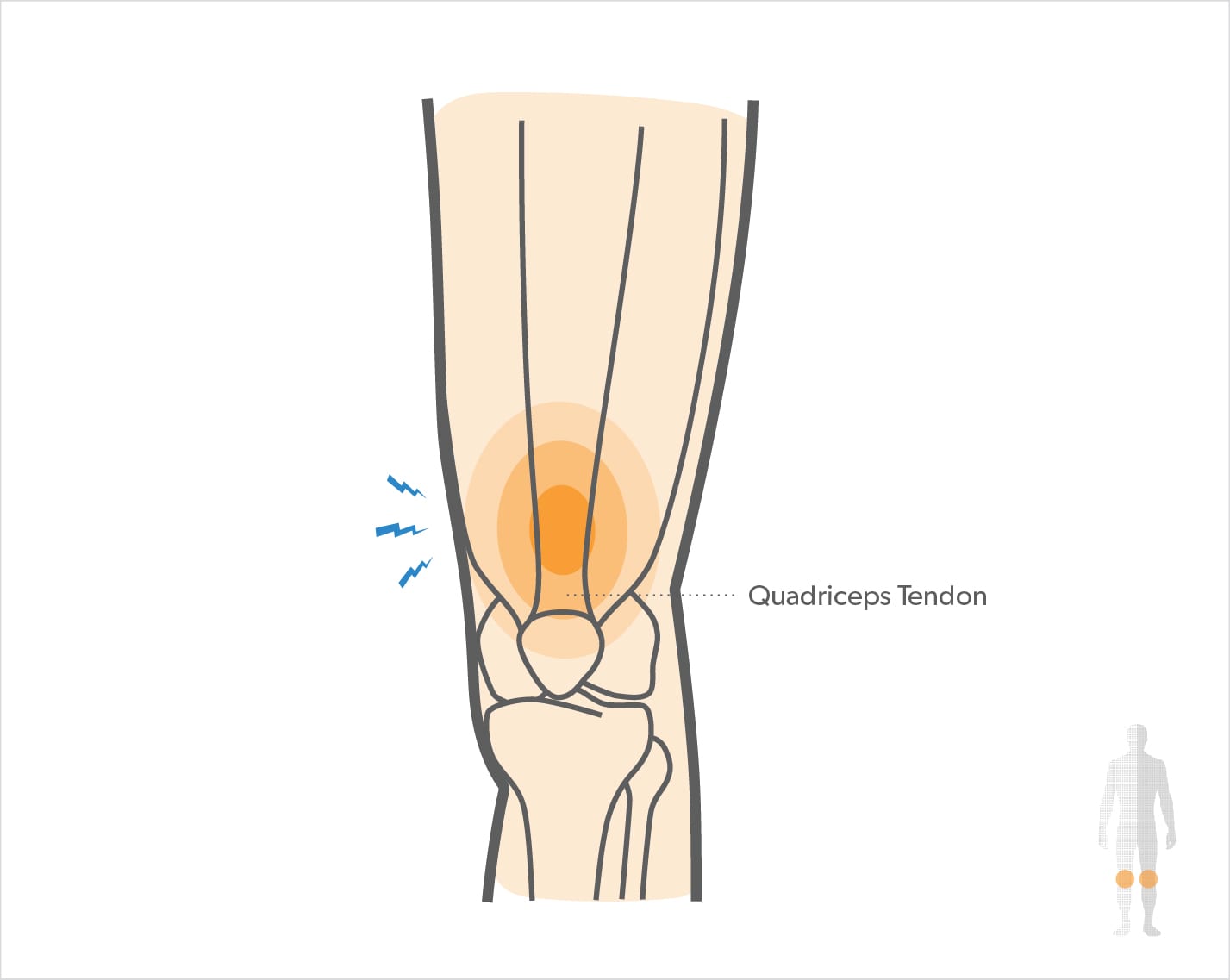 Pain in quadriceps tendon
