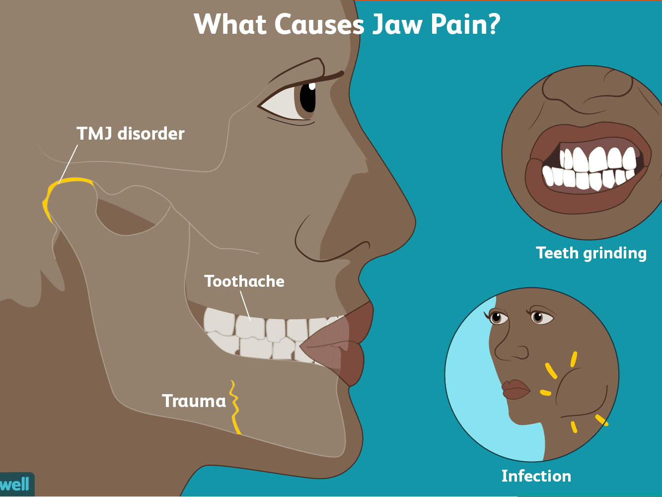 Muscle Pain In Jaw Area Cause Symptoms Treatment Exercise