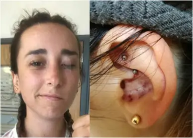 Ramsay Hunt syndrome