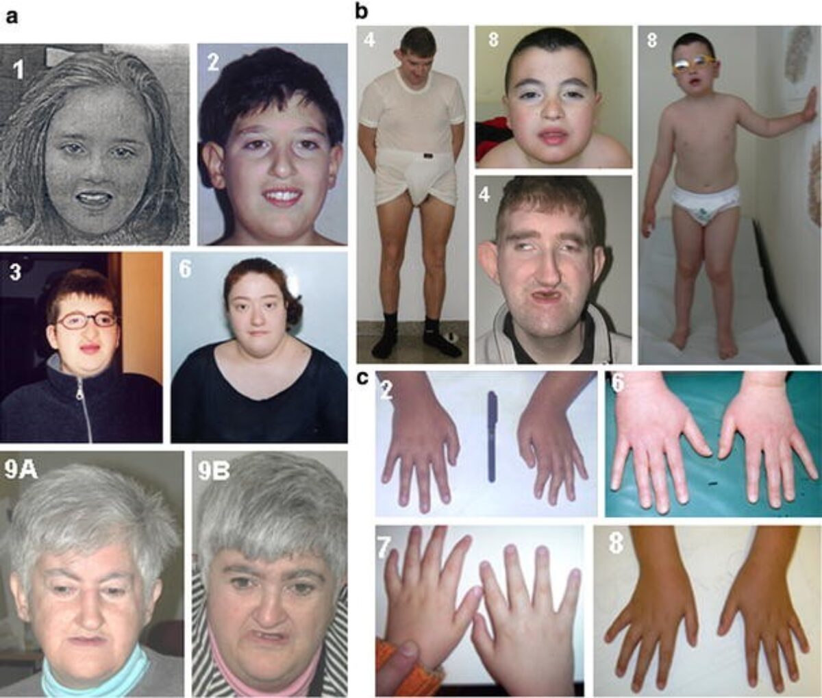 Small and short hands in girl with Cohen syndrome.