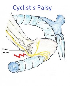 cyclist palsy