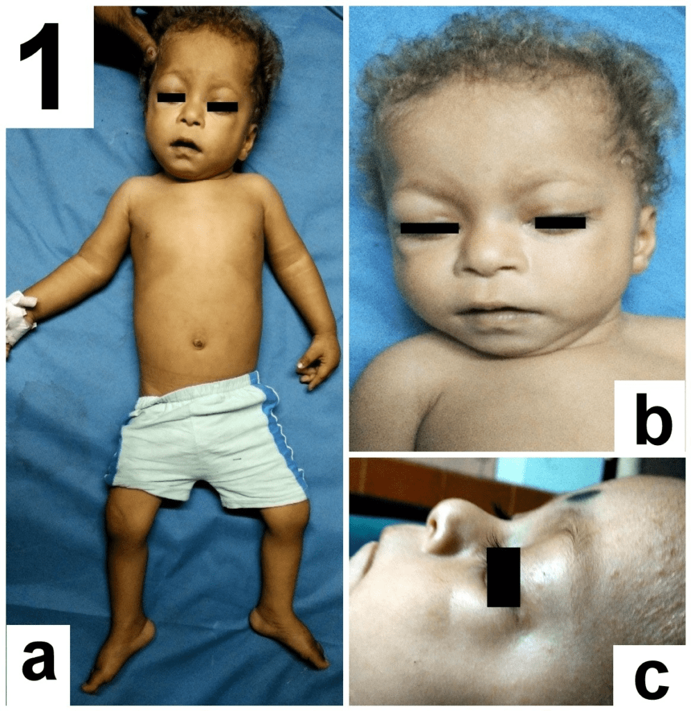 (a)short height and planter flexion of foot   (b) fine hair 
 (c) dry lump on face