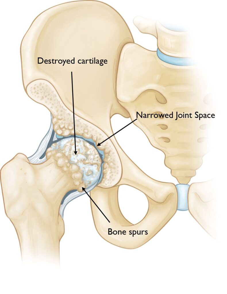 diagnosis of hip osteoarthritis