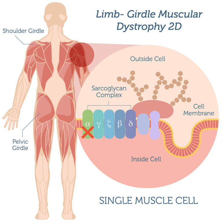 LimbGirdle Muscular Dystrophy (LGMD) Symptoms, Treatment