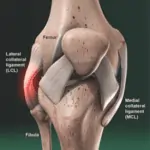 Lateral Collateral Ligament