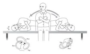 Semont-Toupet maneuver
