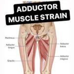 Adductor Magnus muscle strain Cause, Symptoms, Treatment