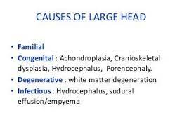causes of microcephaly