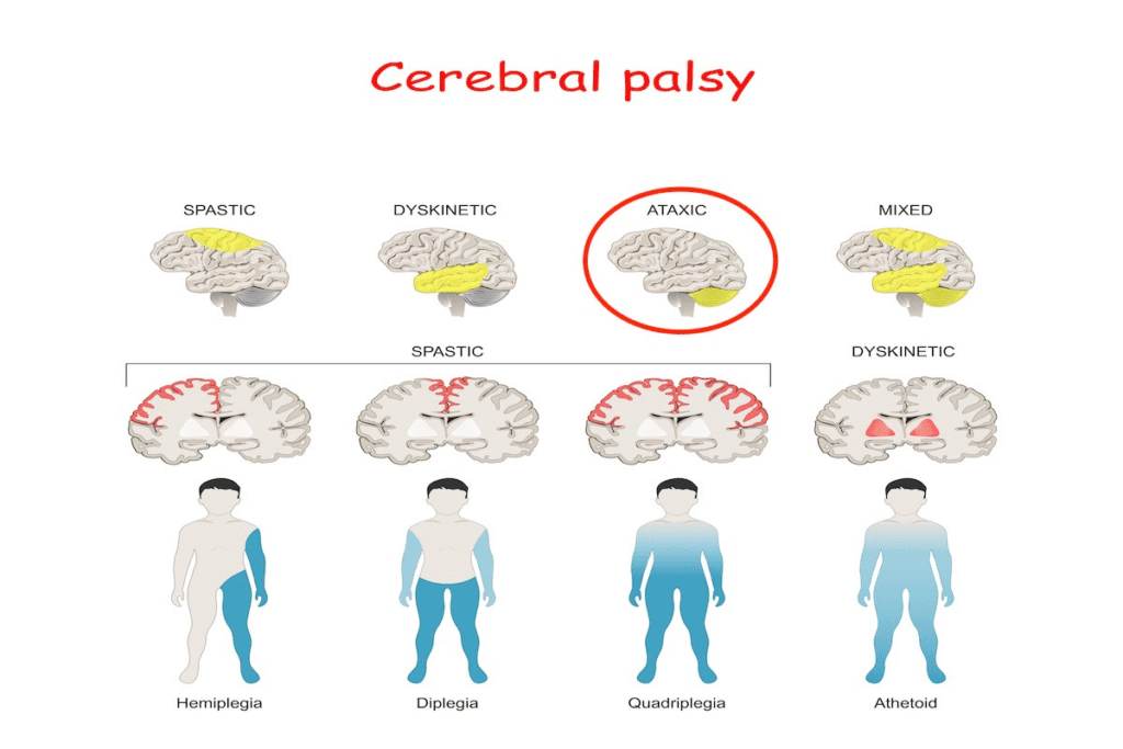 Ataxic cerebral palsy