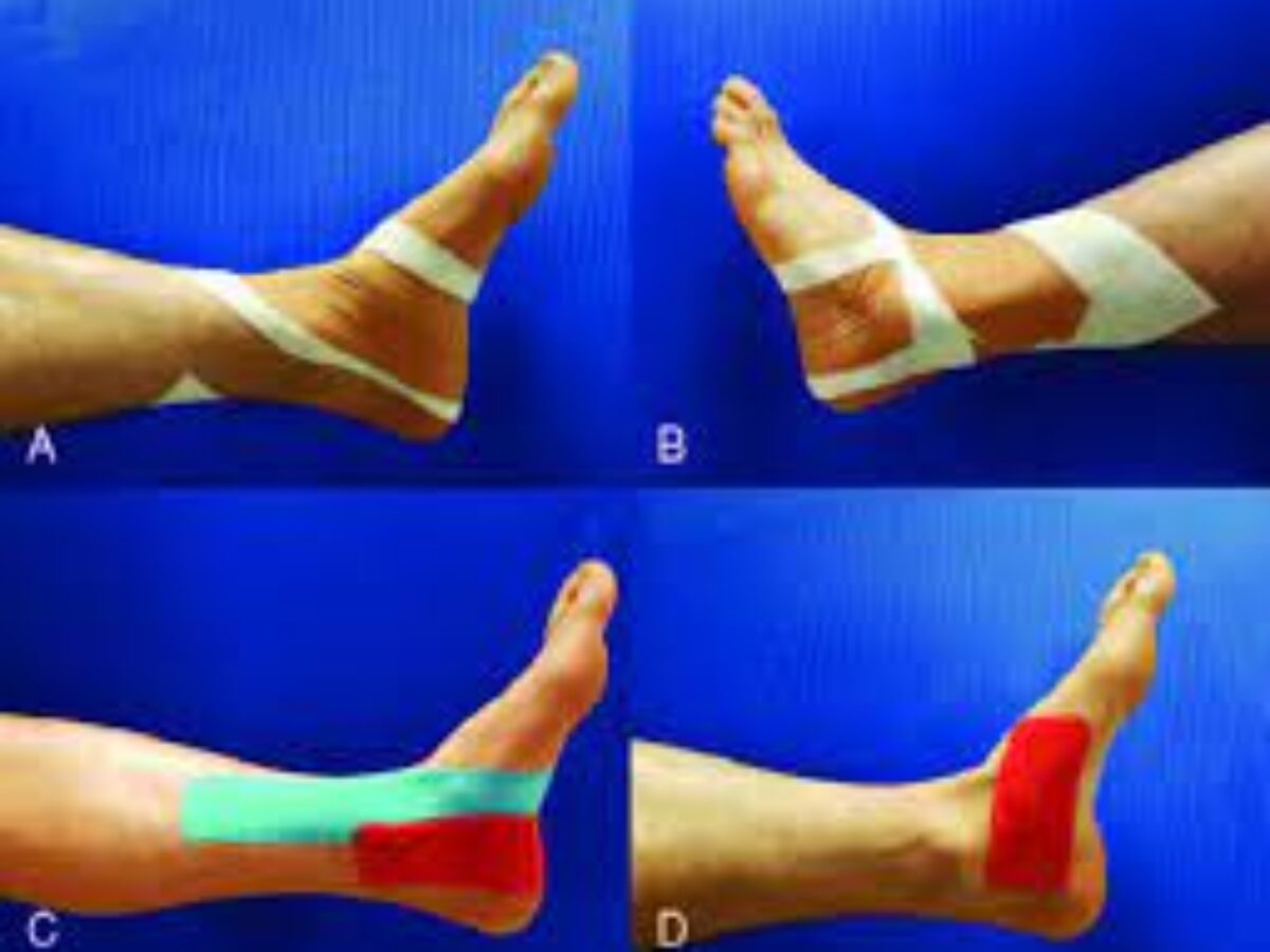 What is Kinesio Taping?: Reddy Care Physical & Occupational