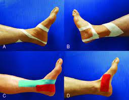 Kinesio Taping Vs Rigid Taping - What's The Difference? 