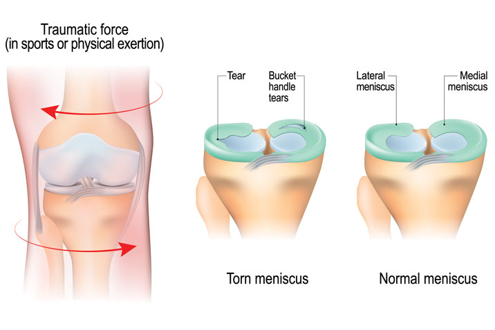 Menisci of the knee joint