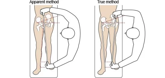 Leg Length Discrepancy