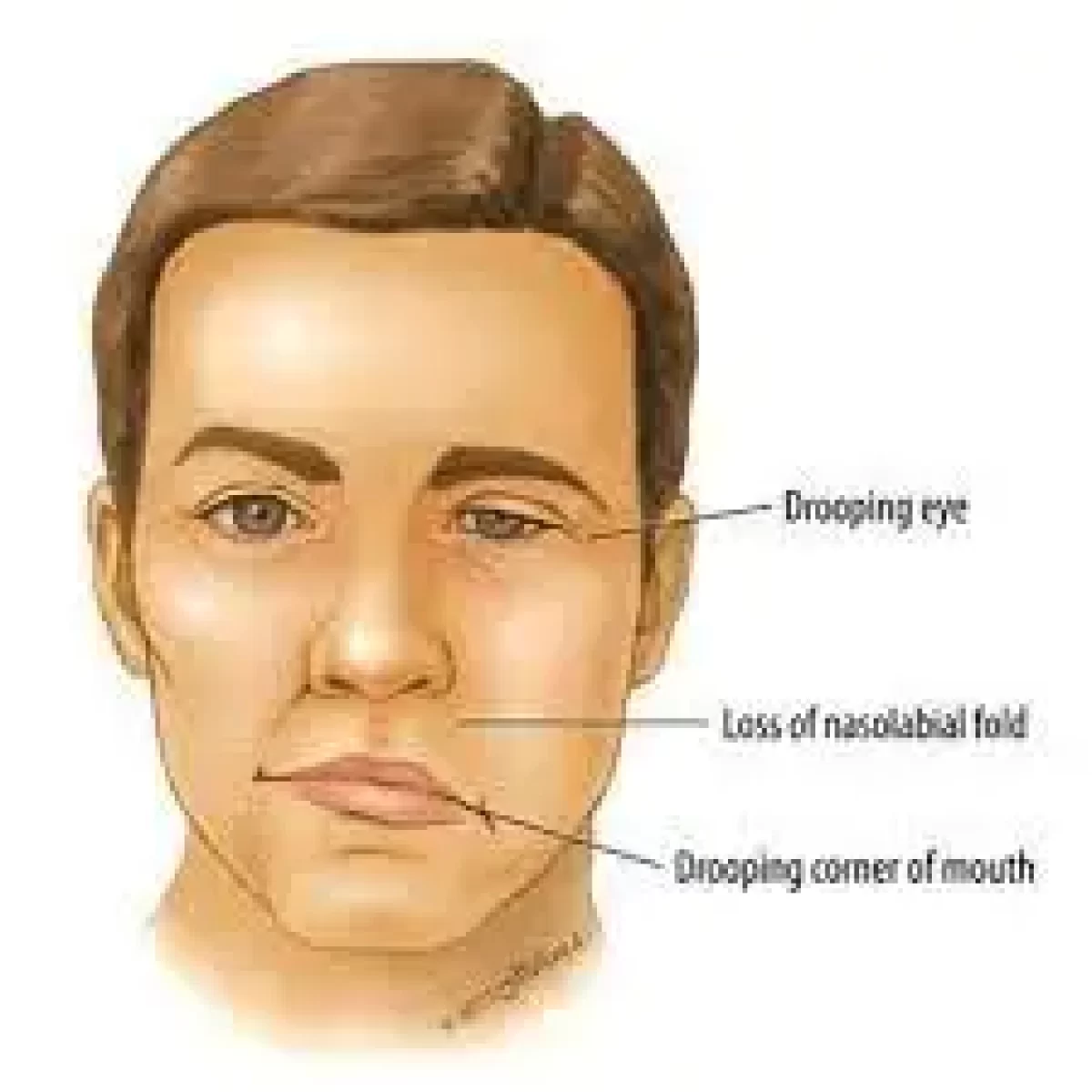 Motor points of face for electrical stimulation of bell's palsy