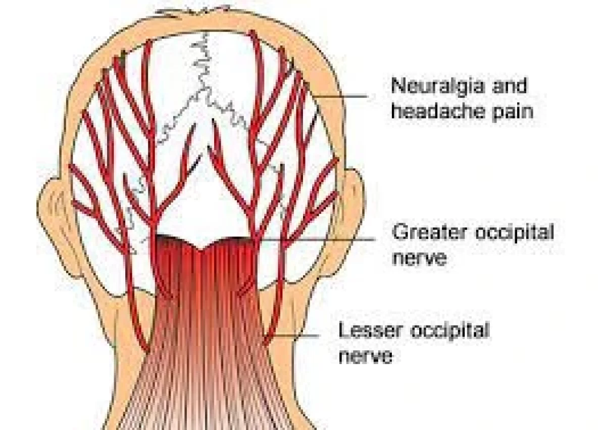 Best pillow for occipital nerve pain hotsell