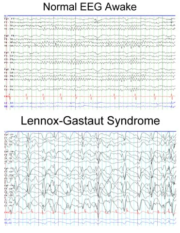 EEG findings of Lennox-Gastaut syndrome