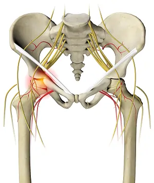 Irritable hip syndrome