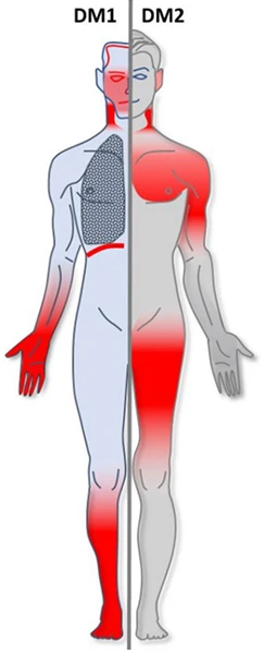 Myotonic dystrophy muscle type