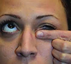 OPMD eyelid ptosis