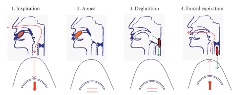 supraglotic swallow