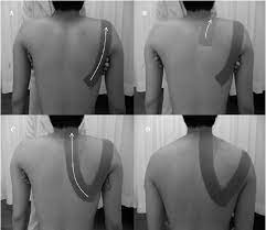 rigid taping for scapular dyskinesia