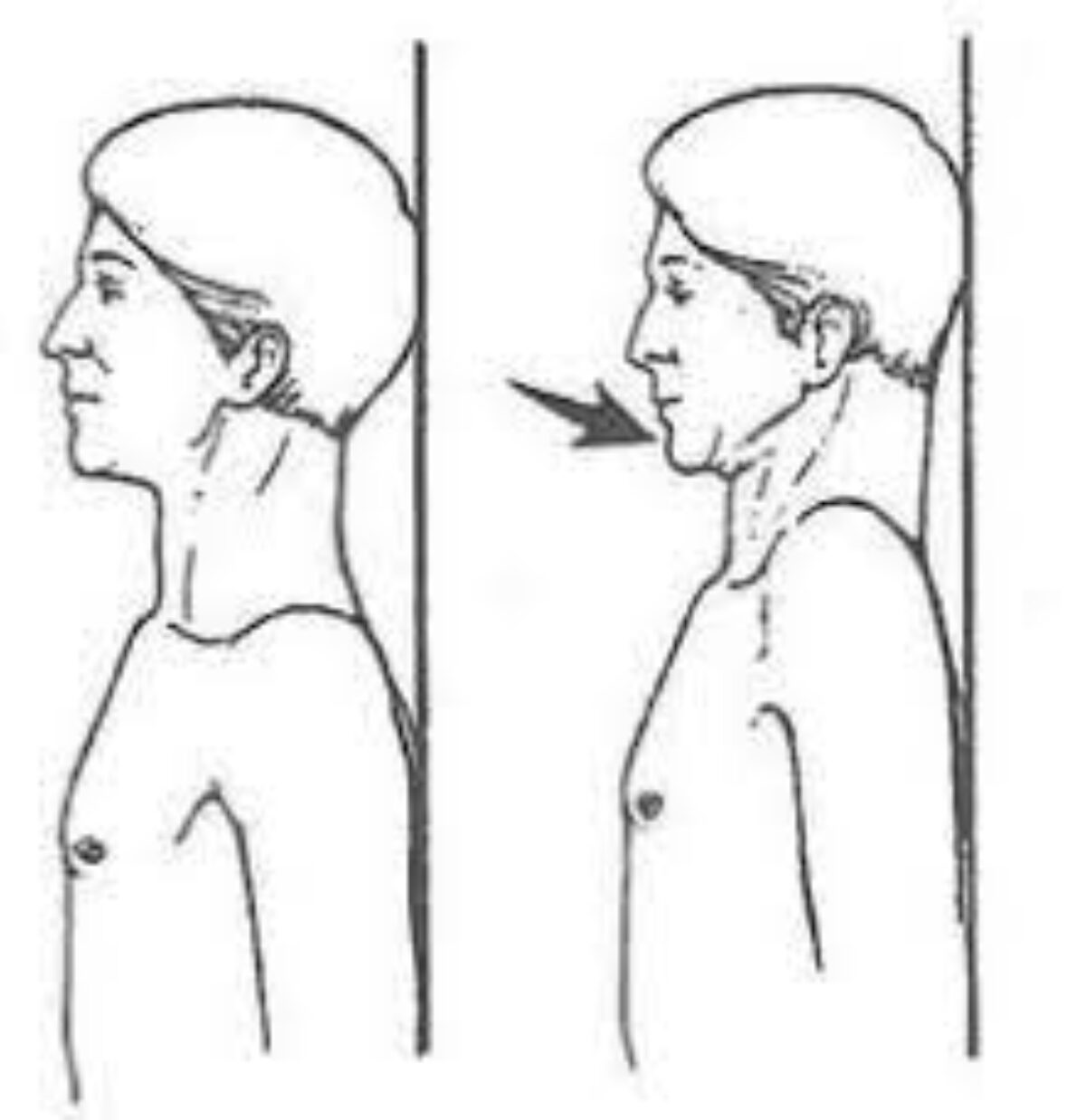 Chin Tucks: Tips and Recommended Variations