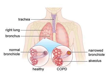 chronic obstructive pulmonary disease (copd)
