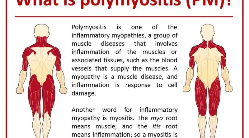 polymyositis early symptoms Archives - SAMARPAN PHYSIOTHERAPY CLINIC ...