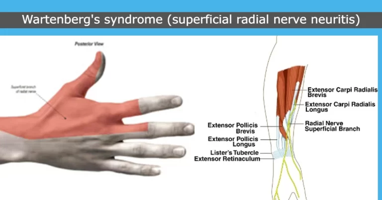 Wartenberg’s syndrome