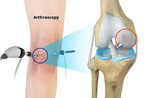 Chondroplasty of knee
