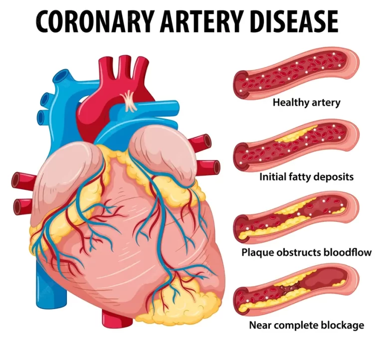 Coronary Artery Disease (CAD)