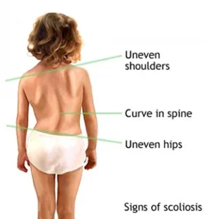 scoliosis