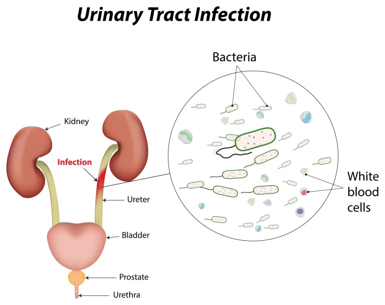 Urinary tract infection (UTI)