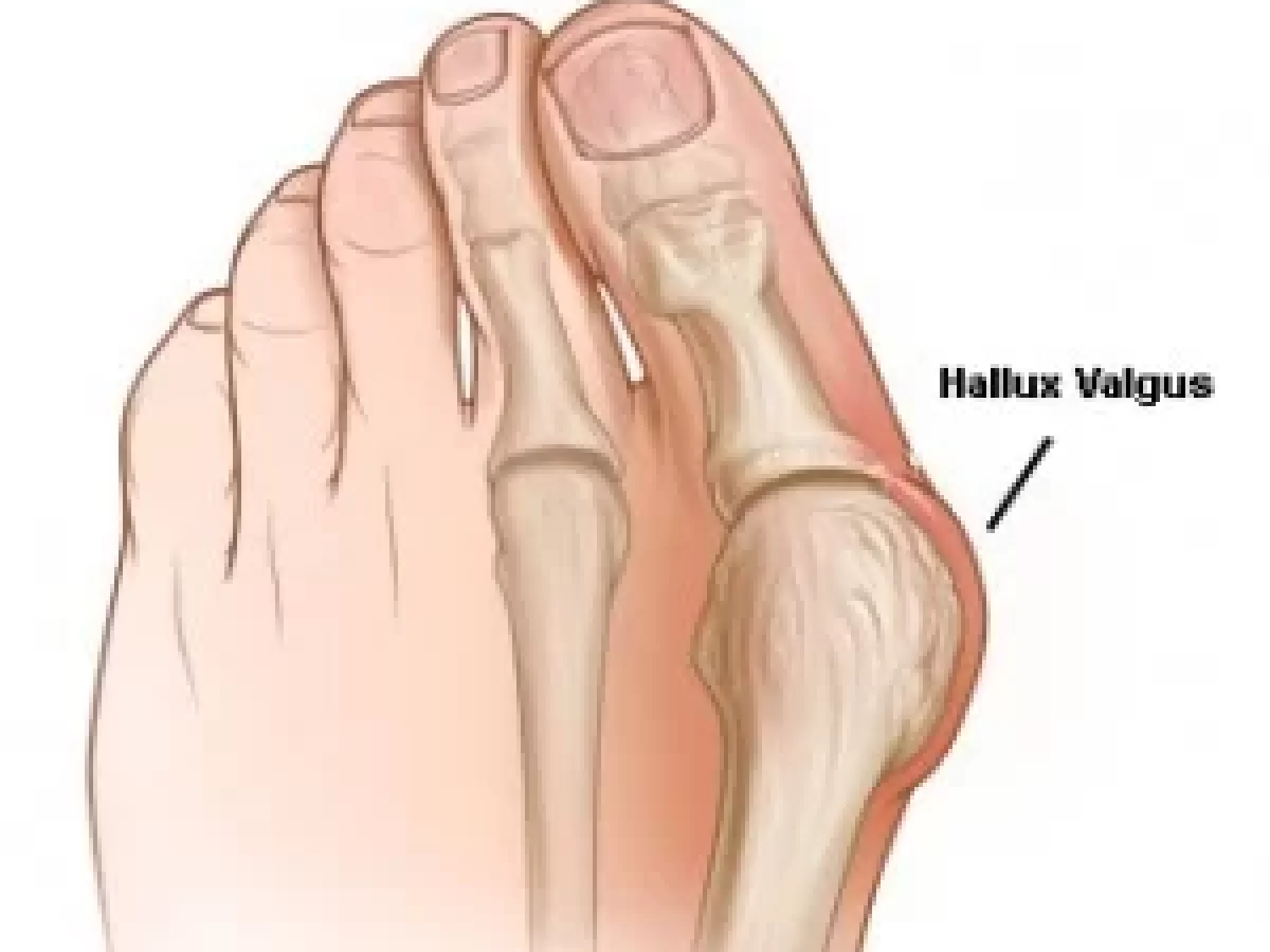 Hallux Valgus foot