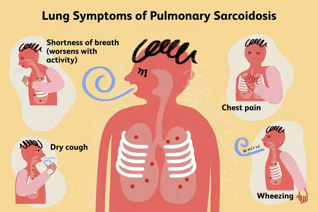 Sarcoidosis Types Cause Symptoms Diagnosis Treatment