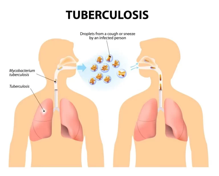 tuberculosis