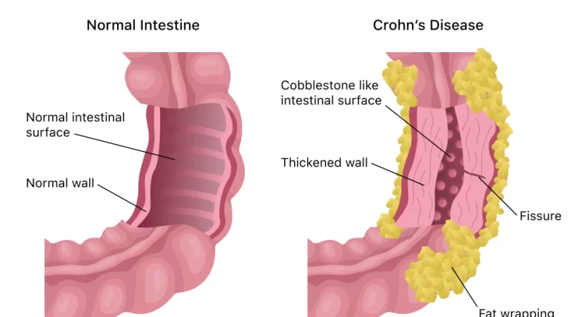 crohn-s-disease-life-expectancy-archives-samarpan-physiotherapy