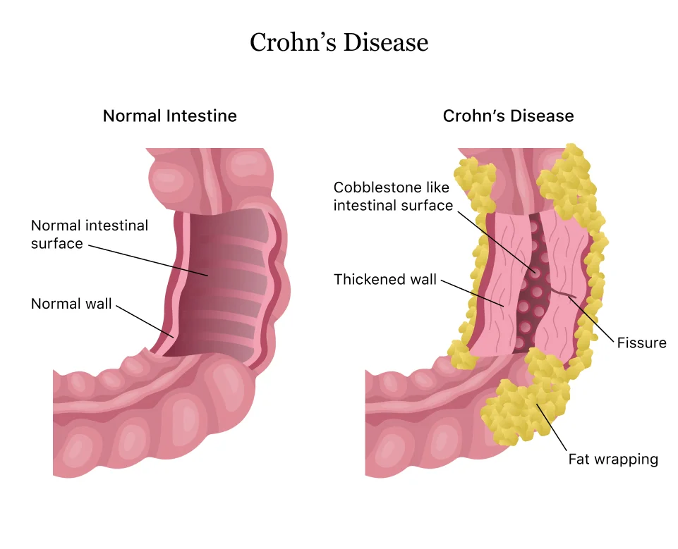 Crohns-Disease