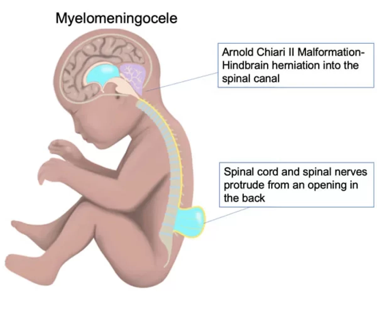 Spina Bifida - Cause, Symptoms, Diagnosis, Treatment