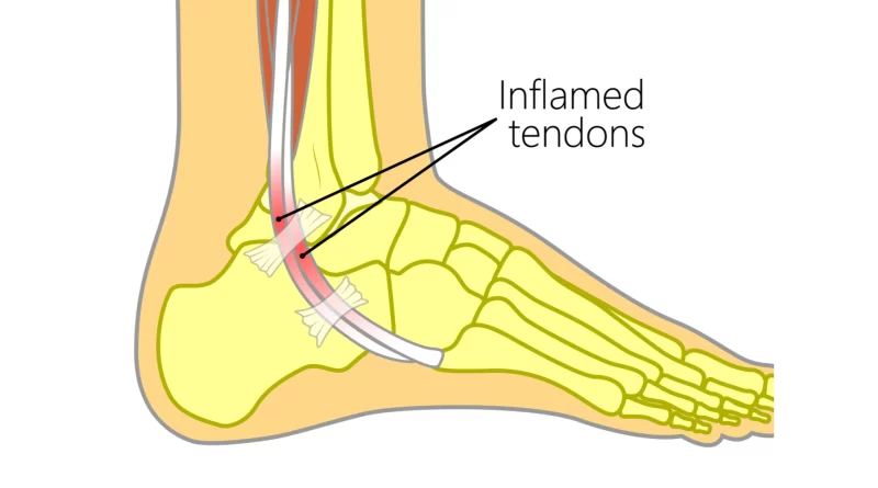 Tendinitis