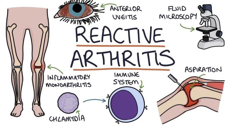 reactive-arthritis-causes-archives-samarpan-physiotherapy-clinic