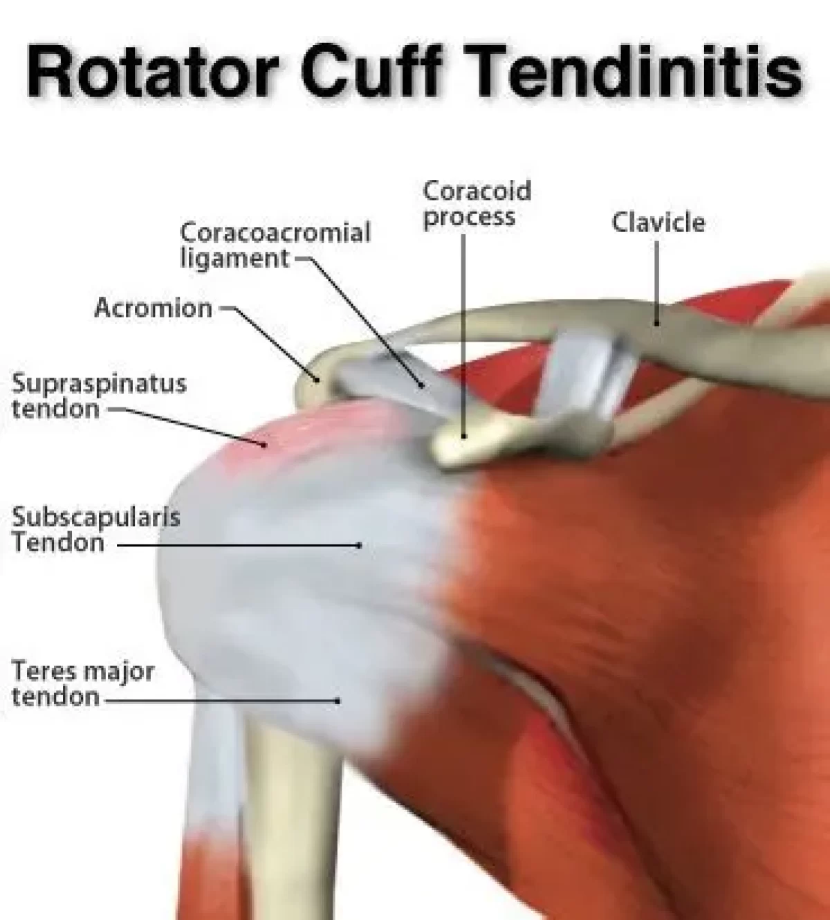 right-supraspinatus-and-subscapularis-tears