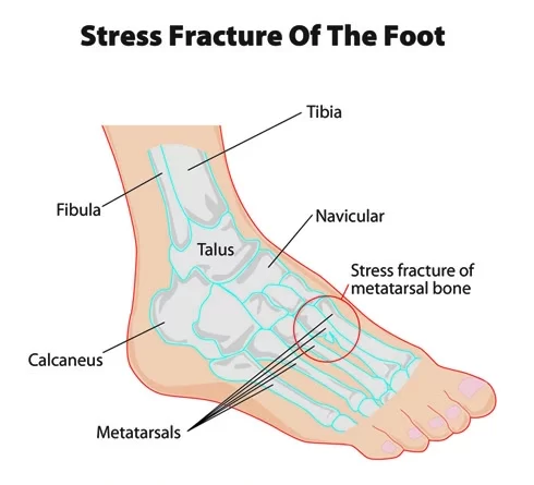 Stress Fracture Foot Archives - Samarpan Physiotherapy Clinic Ahmedabad