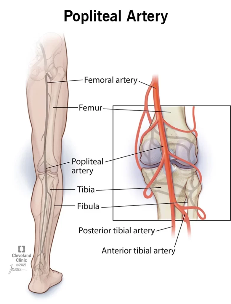 Popliteal artery entrapment syndrome